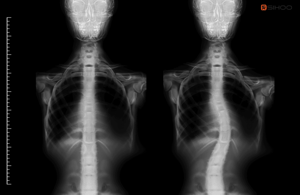 Best Ergonomic Chairs for Scoliosis: Comfort & Support Guide