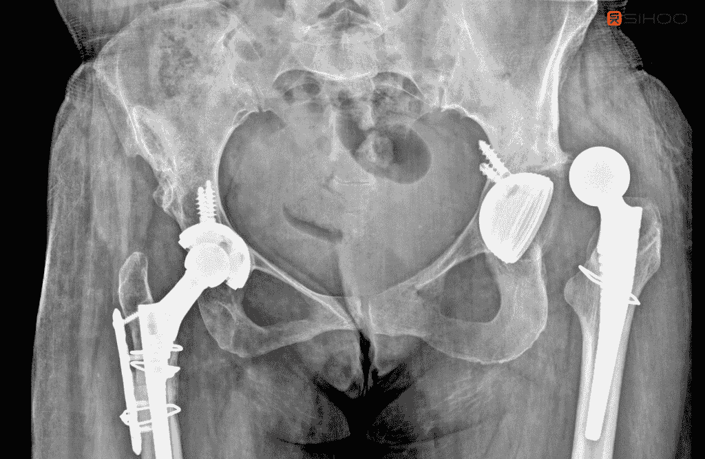 Feeling Lopsided? 7 Key Signs Your Hip Is Out of Alignment